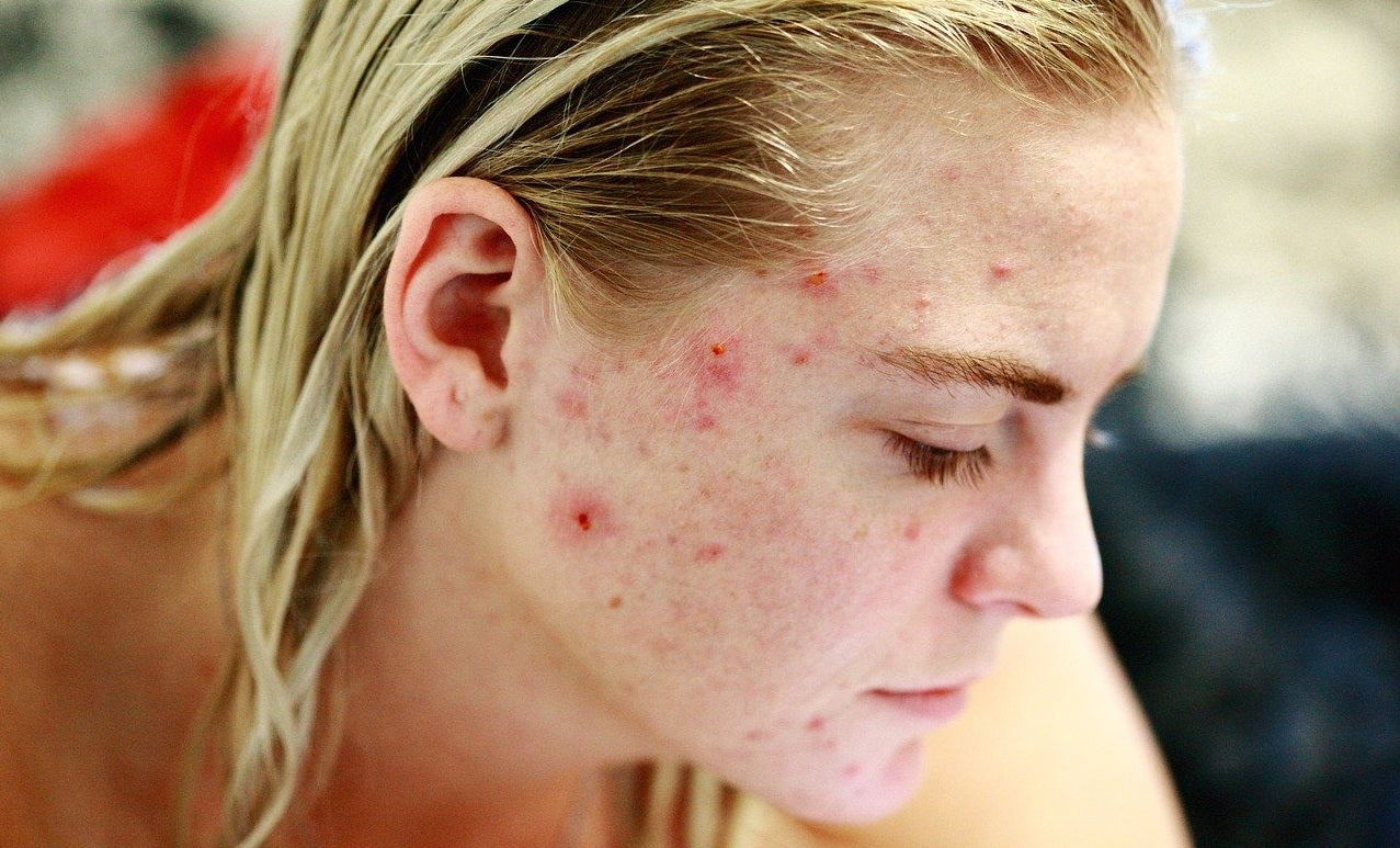 Wie entsteht Akne